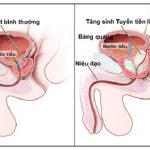 Những vấn đề của lao tiền liệt tuyến