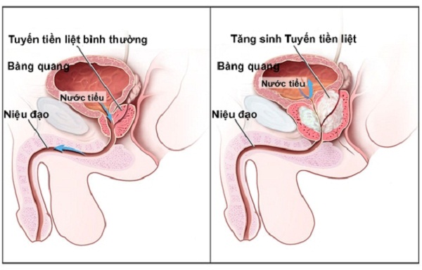 Tiền liệt tuyến